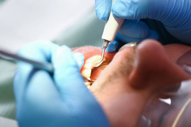 Best Emergency Dental Extractions in Greenville, AL