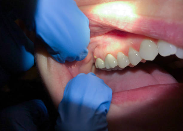 Best Emergency Dental Extractions in Greenville, AL